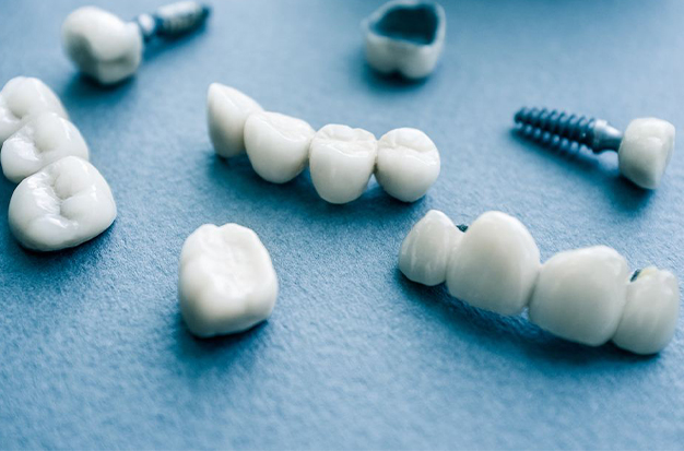 Pros And Cons Of Dental Implants: Is It Right For You?